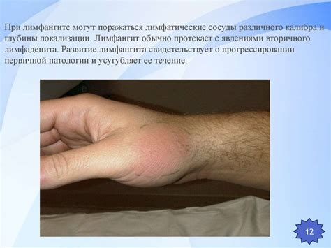 Лимфаденит и лимфангит - презентация онлайн