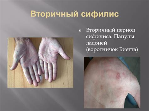 Сифилис. Симптомы сифилиса