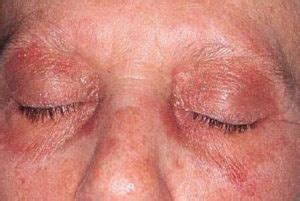 DERMATOMYOSITIS