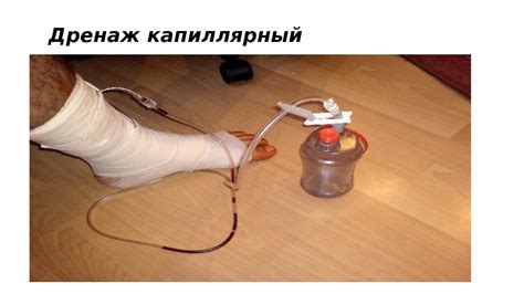Техника выполнения тампонады и дренирования брюшной полости,