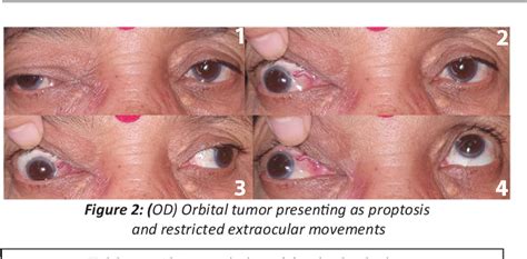 Figure 2 from Revisiting Third Nerve Palsy | Semantic Scholar