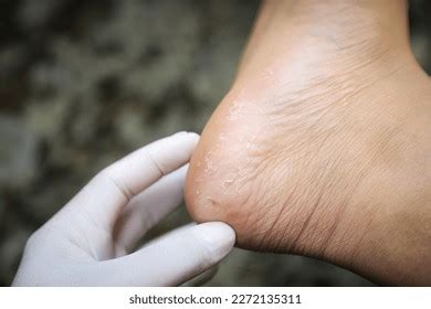 Doctor Hand Checking Pitted Keratolysis On Stock Photo 2272135311 ...