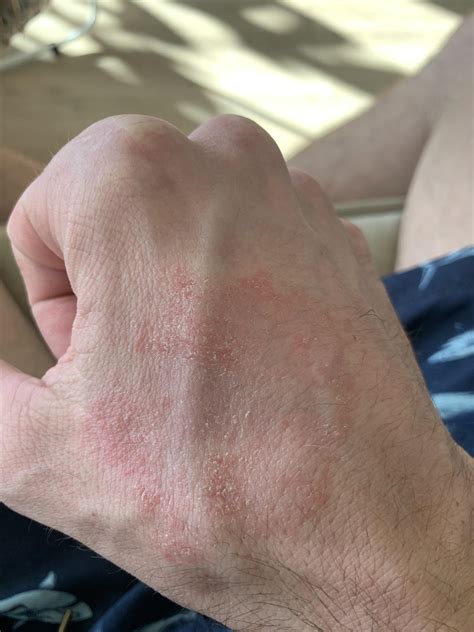 Red rash on skin, anyone else have this? : r/HydrogenSulfideSIBO