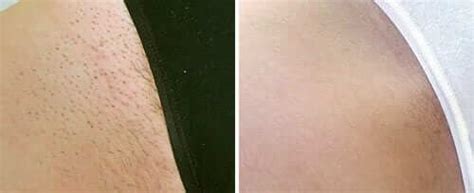 Laser Hair Removal Ottawa | Inovo Medical Aesthetics