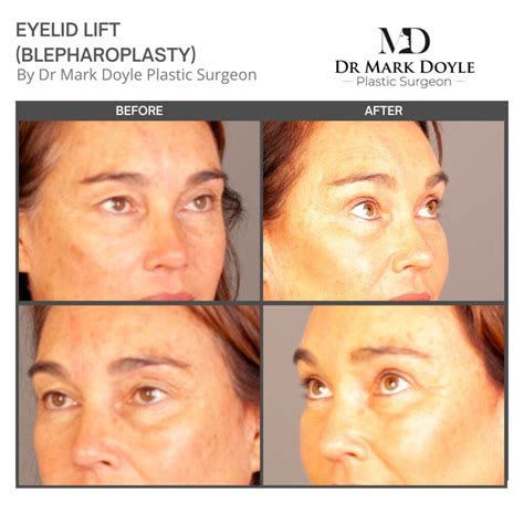 Blepharoplasty Recovery and Scarring | Dr Mark Doyle