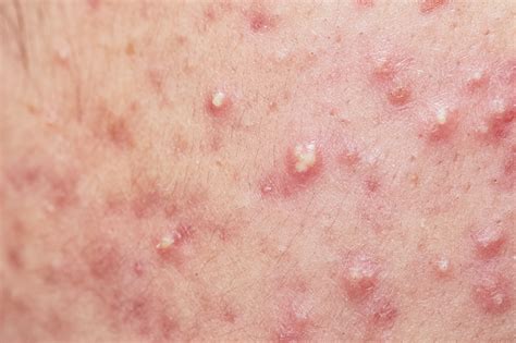 Study Reveals Comparable Efficacy of Clascoterone, Trifarotene, and