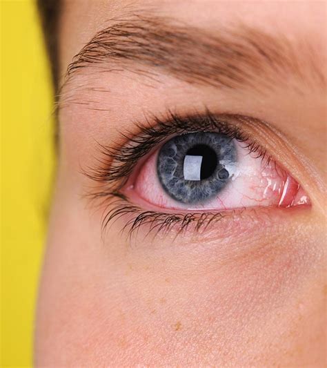 thyroid eye disease   cope  symptoms