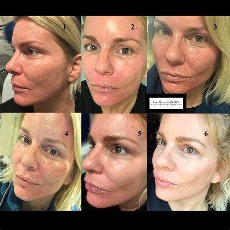 Collection 100+ Pictures Deep Chemical Peel Before And After Photos ...