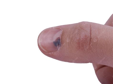 รูปเลือดคั่งใต้เล็บใต้เล็บ PNG , งาน, เทนนิส, เลือดภาพ PNG สำหรับการ