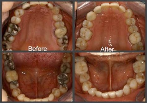 Dental Inlays And Onlays at Dentists Esthetix Dental Spa, NY