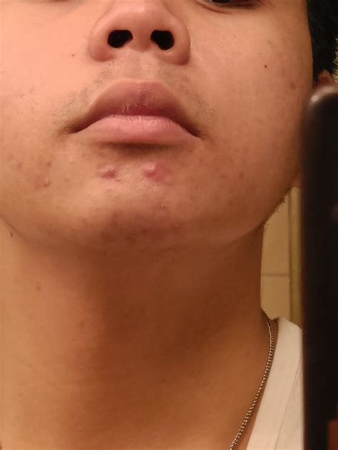 HOW TO REMOVE PERSISTENT ACNE : r/acne