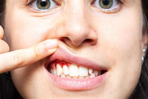 how to make gums stop bleeding