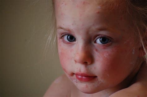 Lille vakre Anna og Marte: Vannkopper som bestillt!