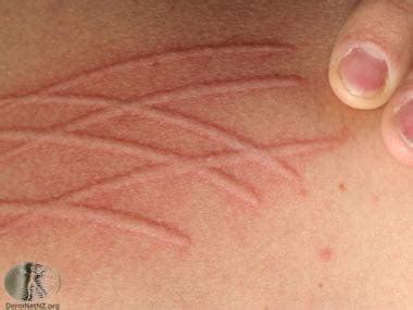 Dermographism Urticaria: Practice Essentials, Pathophysiology and ...