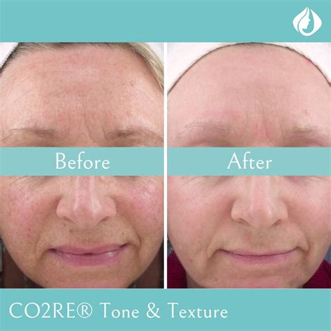 CO2RE® Laser Skin Resurfacing Toronto, North York, Markham | La ...