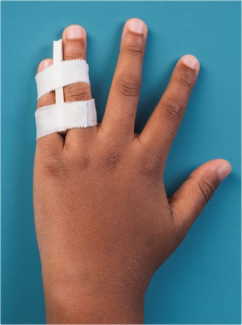 buddy taping  reduction  displaced extra articular phalangeal