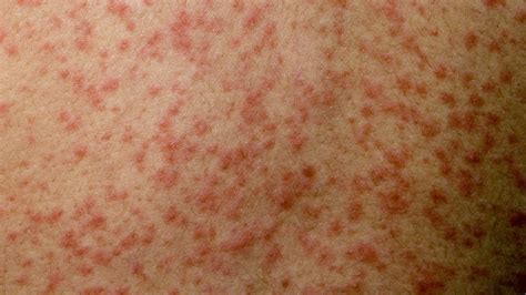 measles spreading   festivals bbc news