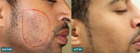 Ingrown Hairs | Dermatology & Laser Surgery Center