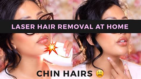laser hair removal  home thick chin hairs   youtube