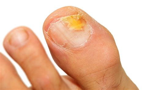 treated  ingrown nails athletes foot fungus