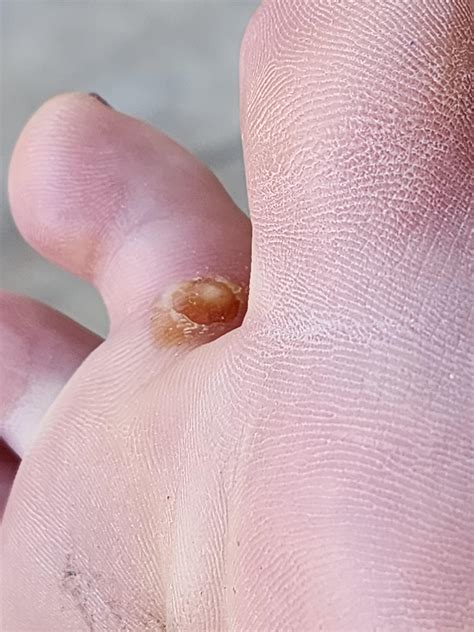 Deroofed Blister, Infected or Not? : r/firstaid
