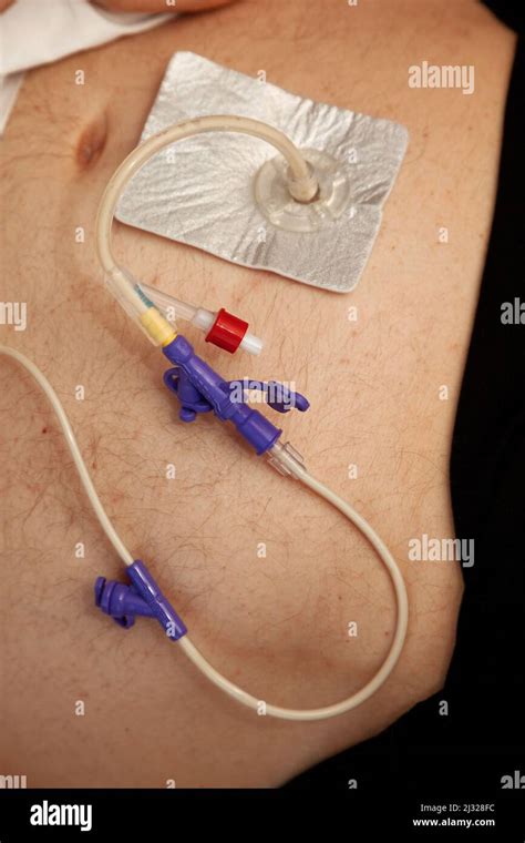 Percutaneous endoscopic gastrostomy (PEG) is an endoscopic medical ...