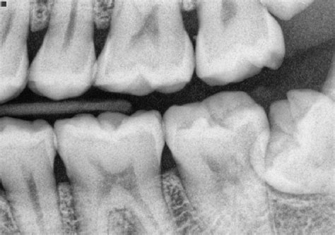 Дентални Рентгенови Снимки | Новини | Dental.bg