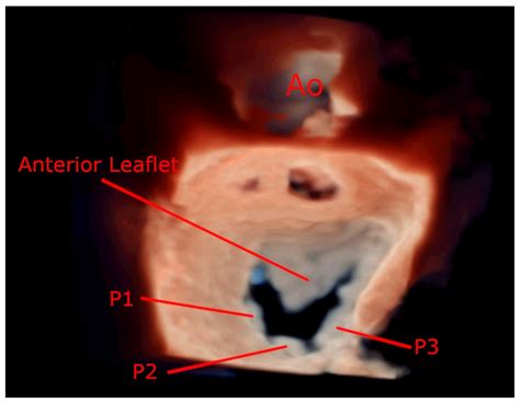 The Role of 2D and 3D Echo in Mitral Stenosis