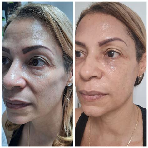 Estimulador de Colágeno – Novetafill | Clínica Estética Carvajal