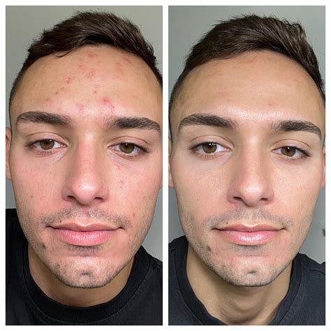 weeks progress   cream rtretinoin