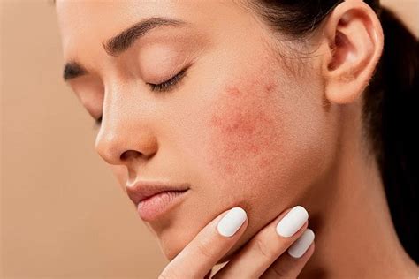 Skin break out treatment for all phases of skin break out - Inspire exam