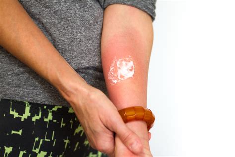 How to identify and get rid of an amoxicillin rash?