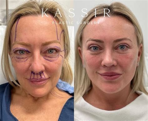 Before and After Facelifts. All healing stages and tips for a quick ...