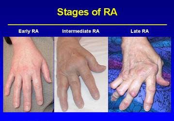 Rheumatoid Arthritis: Causes, Symptoms and Treatment | IYTmed.com