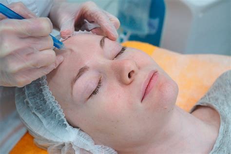 Лечение купероза на лице лазером: отзывы, фото | Beauty Insider