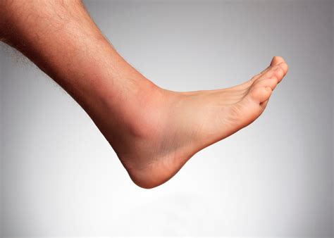 Swelling in One Foot | Next Step Foot & Ankle Clinic