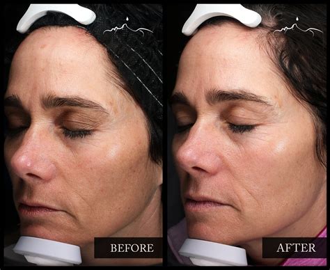 BBL Laser Treatment – Conklin Clinics