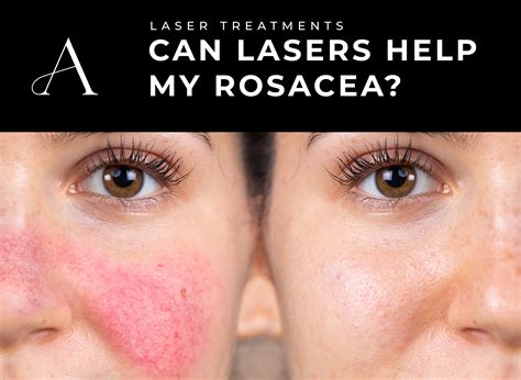 Effective Laser Treatments For Acne | What You Need To Know