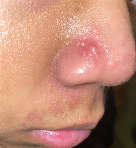 Acne Rosacea Vs Acne Vulgaris Laser & IPL Acne Treatment ⋆ Sophia