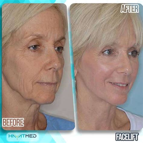 How Much Is A Facelift Cost: Ultimate Guide By Type For 2024