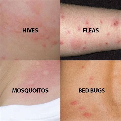 What Do Flea Bites Look Like Human - what do does