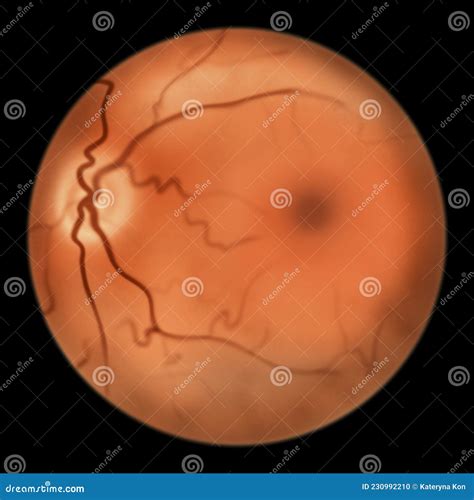 Normal Vessels And Arteriovenous Malformation Avm Vector Illustration