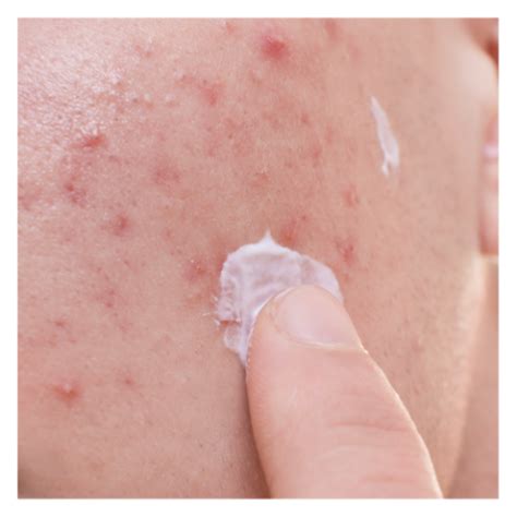 Acne Fúngica Como Tratar - ACNE FÚNGICA: SAIBA O QUE É E COMO TRATAR - Blog Ada Tina