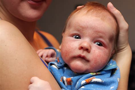 Jak poznat atopický ekzém u dětí? - EPIDERMA®