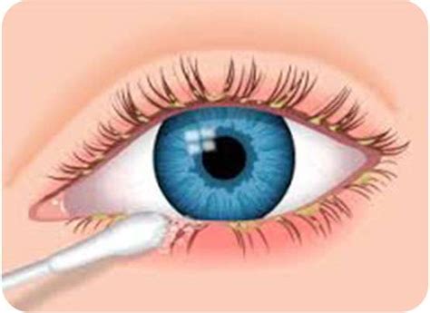 Eye Blepharitis Treatment | Blepharitis Management