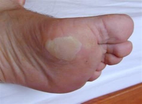 podiatrist discusses  treatment  blisters