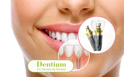 Дентиум (Dentium) импланты в Москве - качественная установка по ...