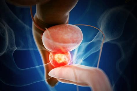 50 Facts About Prostate Cancer - Facts.net