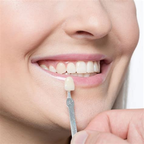 What Are Veneers?