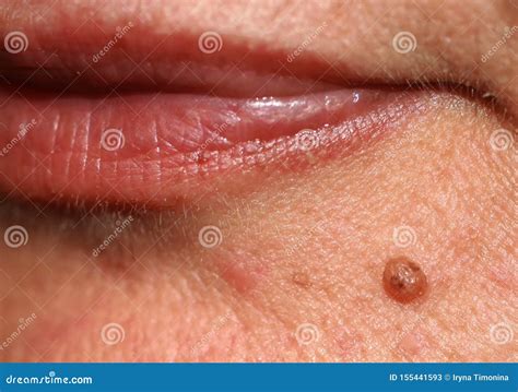 Moles on the Chin. Birthmark on His Chin. Stock Image - Image of ...